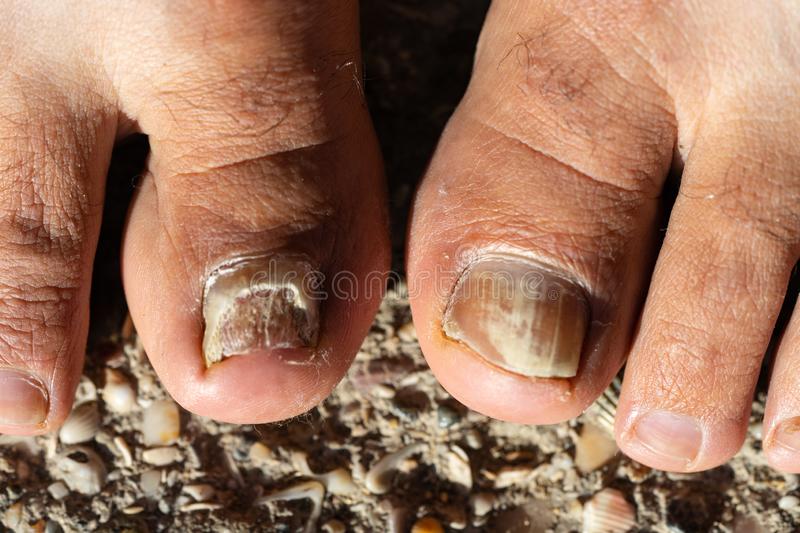 candida-albicans-close-up-foot-toe-155352799