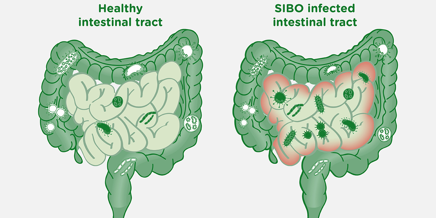 SIBO-imsge--1440x720